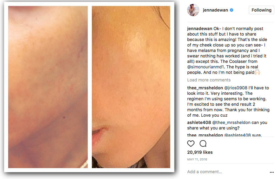 Jenna admits she's tried everything to get rid of her discolouration. Photo: Instagram