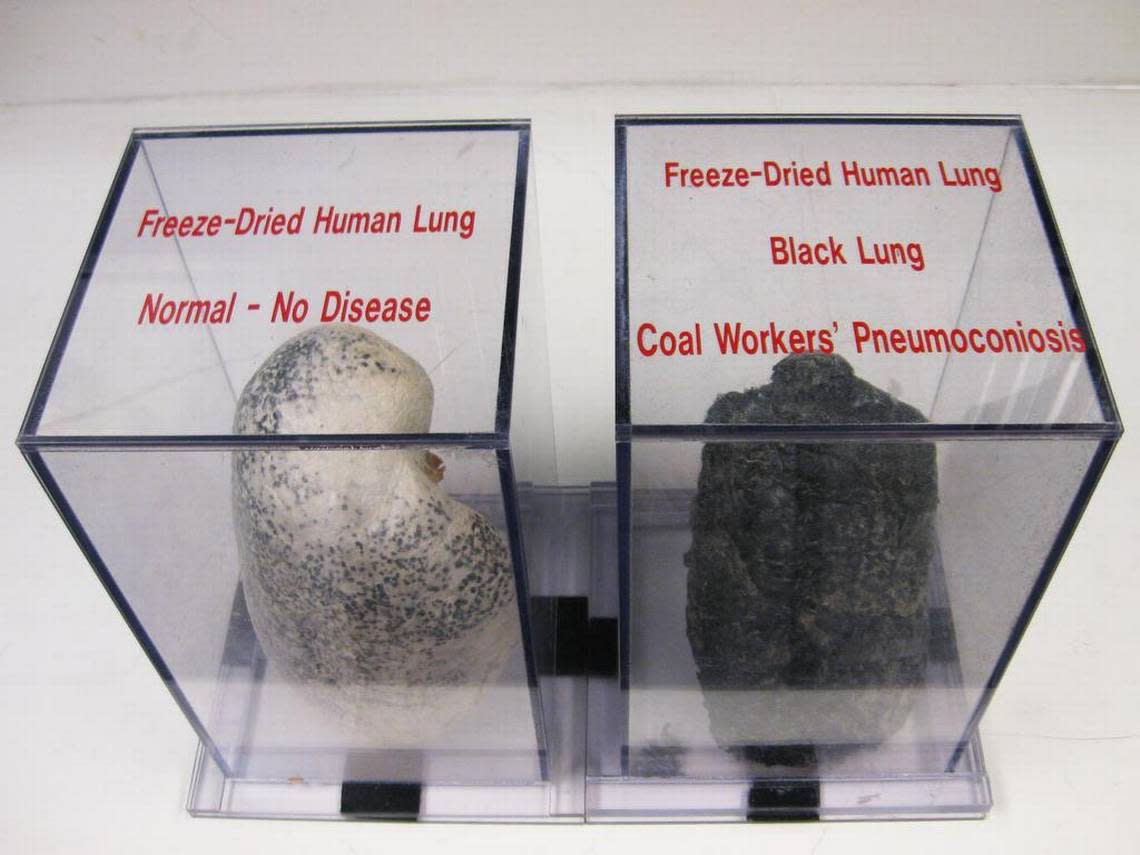 A display case at NIOSH shows a normal lung and a diseased black lung, caused by inhaling coal dust and other harmful particles while coal mining.