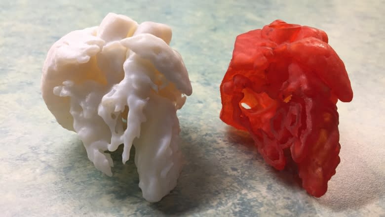 3D printer lets surgeons hold a child's heart before surgery starts