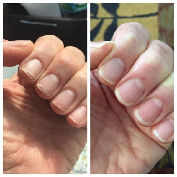 A before image of a reviewer's brittle nails and an after image of them much heaithier