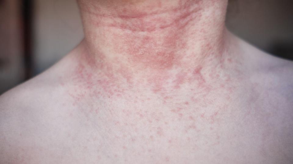 allergic reaction due to contact with animals on human skin