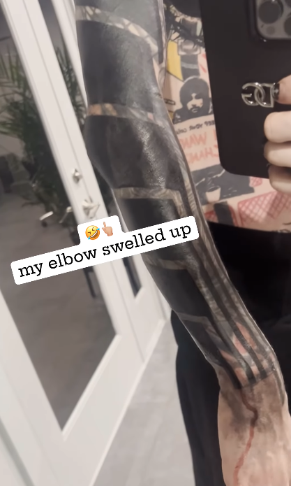 Person holding a phone reflects in a mirror, showing a swollen elbow with a text overlay "my elbow swelled up"
