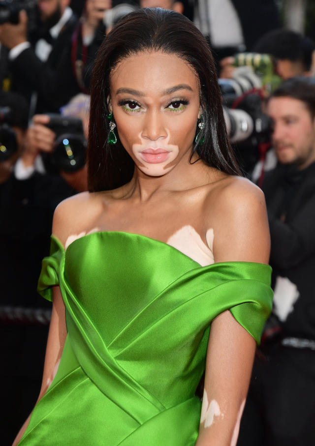 Winnie Harlow Says America's Next Top Model “Didn't Do Anything” for Her  Career