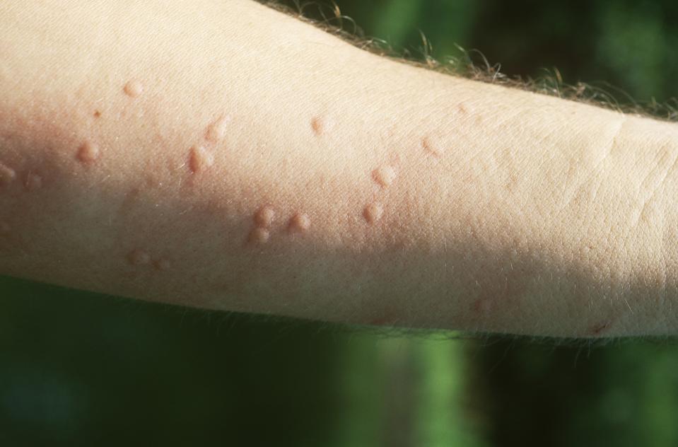 Sensitive skin complaint #2: Allergic reactions