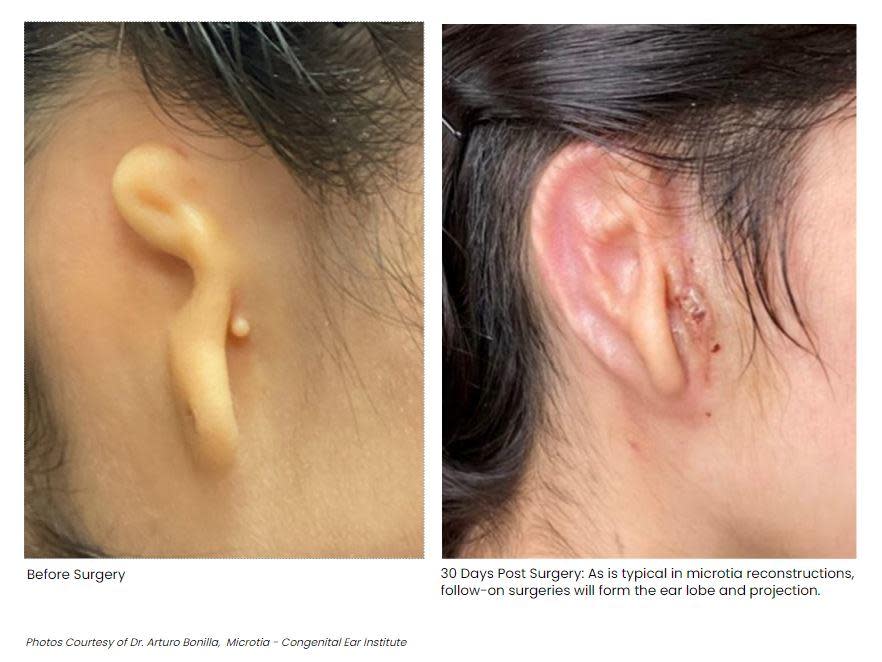 This image shows what the 20-year-old patient's ear looked like both before and after she received the 3D-bioprinted transplant.  / Credit: Dr. Arturo Bonilla