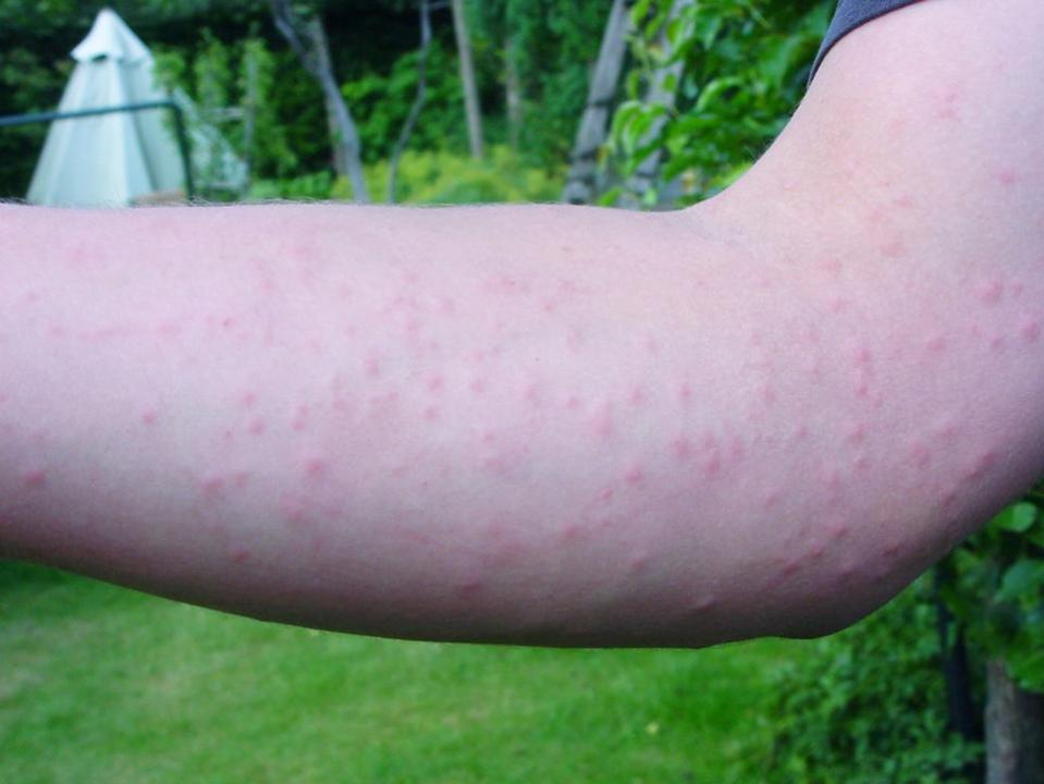 Eastern Daily Press: A skin rash caused by the oak processionary moth