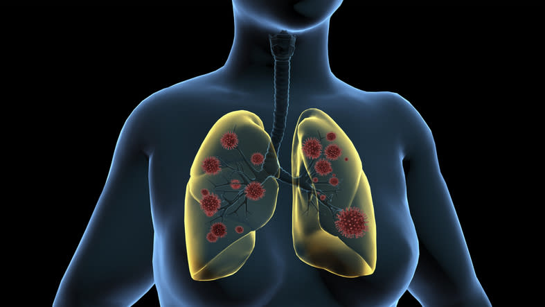 Enfermedades respiratorias agudas: cuáles son, síntomas, diagnóstico, tratamiento 