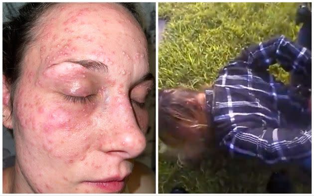 Taylor Rogers has accused police in Santa Fe, Texas, of using excessive force and holding her face over a pile of fire ants in 2021.