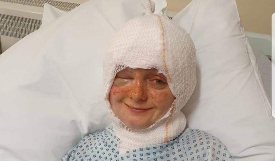 Emily was treated for second and third degree burns to her face, neck and head. (SWNS)