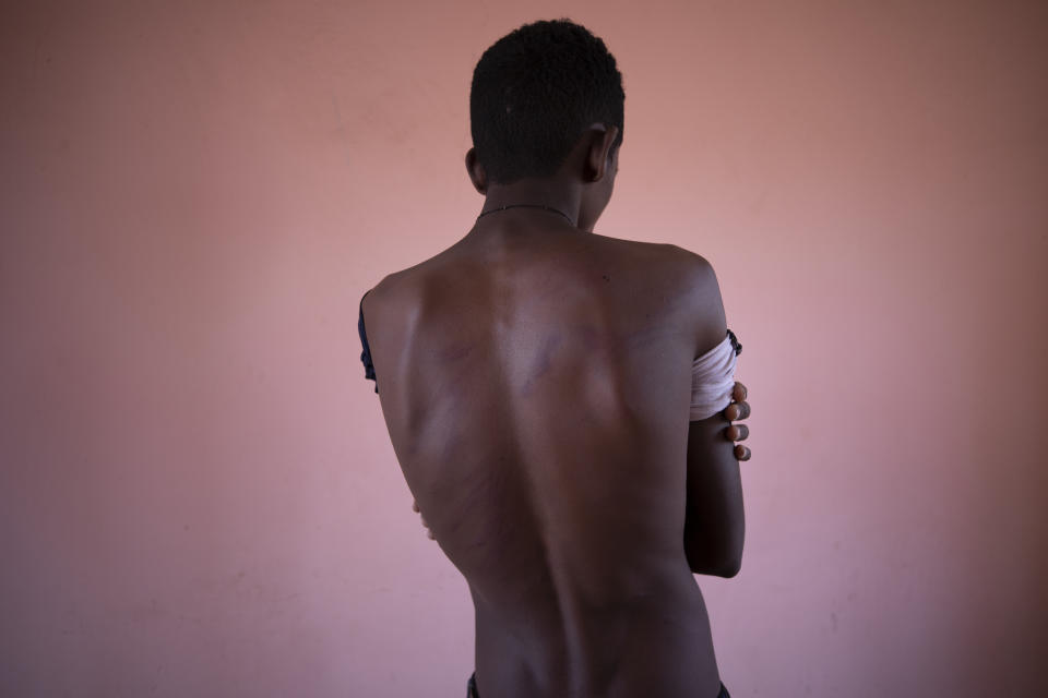 Fisseha Welay, an 18-year-old Tigrayan student who fled the conflict in Ethiopia's Tigray, shows the wounds on his back from being beaten by Eritrean soldiers, hours after his arrival to Hamdayet, eastern Sudan, near the border with Ethiopia, on March 17, 2021. The atrocities have been seared into the skin. They arrive in heat that soars above 100 degrees, carrying the pain of gunshot wounds, torn vaginas, fresh welts on malnourished backs from beatings. Unseen are the horrors that jolt them awake at night. Bodies strewn on riverbanks. (AP Photo/Nariman El-Mofty)