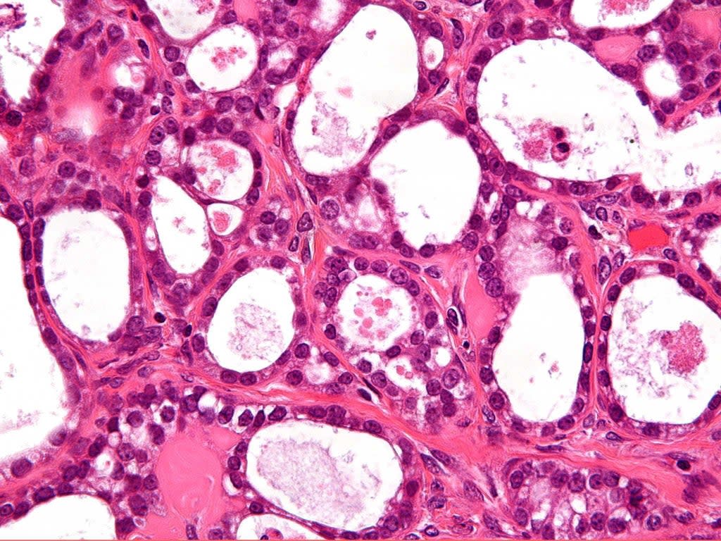 Researchers note kidney cancer is only form of cancer that takes longer to obtain treatment for (Nephron via Wikimedia Commons)