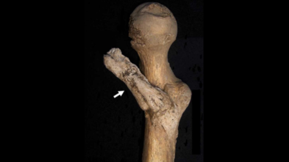 The skeleton was the first documented case of a bone growth in this location caused by trauma, according to the study.