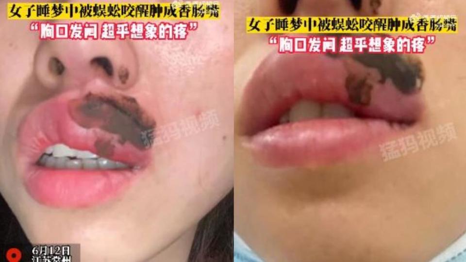 女子半夜被蜈蚣咬醒，且嘴唇在短短幾秒後便腫得跟香腸一樣。（圖／翻攝自微博）