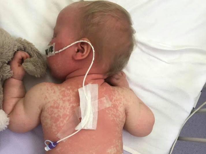 Mother shares ‘heartbreaking’ photos of baby girl with measles ‘to educate about vaccinations’