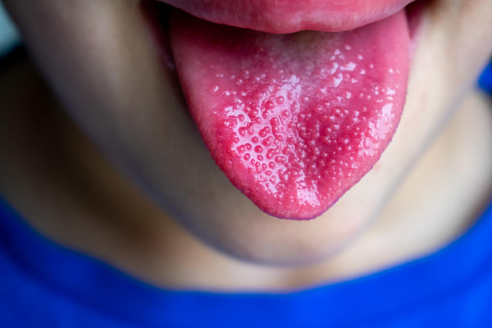鏈球菌草莓舌日本