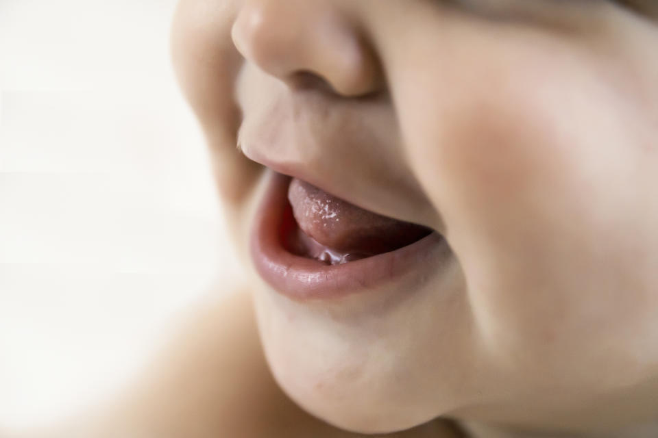 Some babies can develop breastfeeding difficulties or speech impediment later on without a tongue-tie division. (Getty Images)