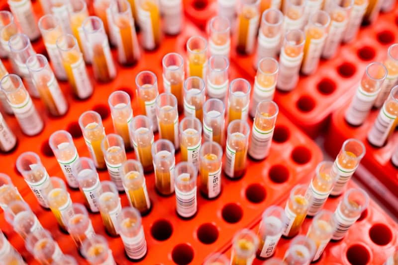 Combining artificial intelligence (AI) with a simple blood test could help diagnose sepsis faster and single out patients at the highest risk of severe complications from the infection, a study has suggested. Rolf Vennenbernd/dpa