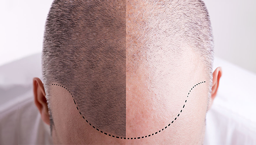 Hair Loss Solutions for Men: Top 5 Treatments for Balding and Thinning Hair Lines