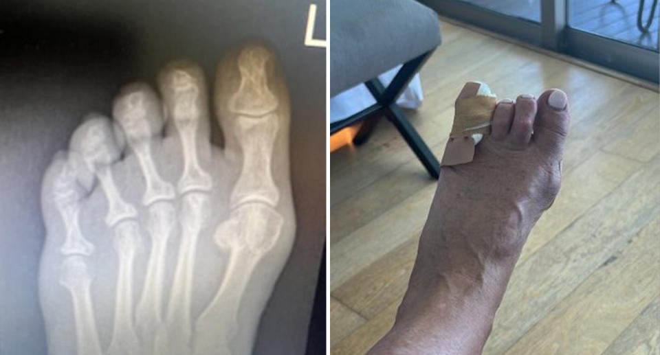 Left, an x-ray of the Virgin passenger&#39;s foot can be seen. Right, Kay Schubach&#39;s left foot can be seen with bandages covering her smallest toe.