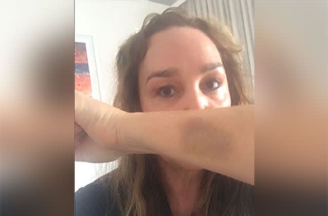 Earlier this week Kate showed off a bruise from the alleged attack outside her St Kilda home. Source: Kate Langbroek / Twitter