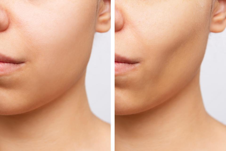 Before and after plastic surgery buccal fat pad removal.