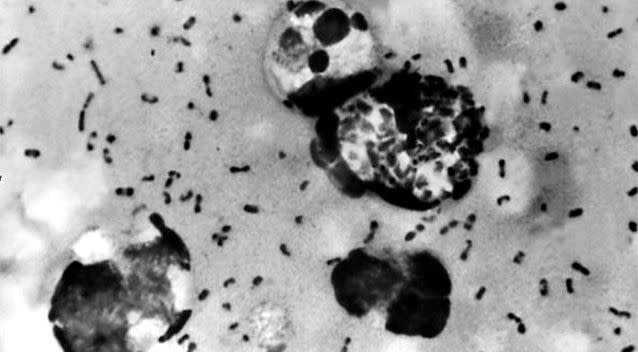 A bubonic plague smear, prepared from a lymph removed from an adenopathic lymph node, or bubo, of a plague patient, demonstrates the presence of the Yersinia pestis bacteria that causes the plague. Photo: Getty.