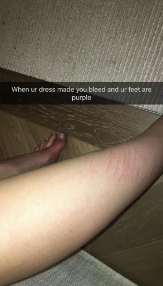 Kylie showing leg with red marks, with text about dress discomfort and purple feet