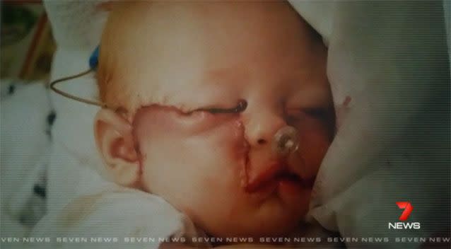 Part of Zoe's face was missing when she was born. Photo: 7 News