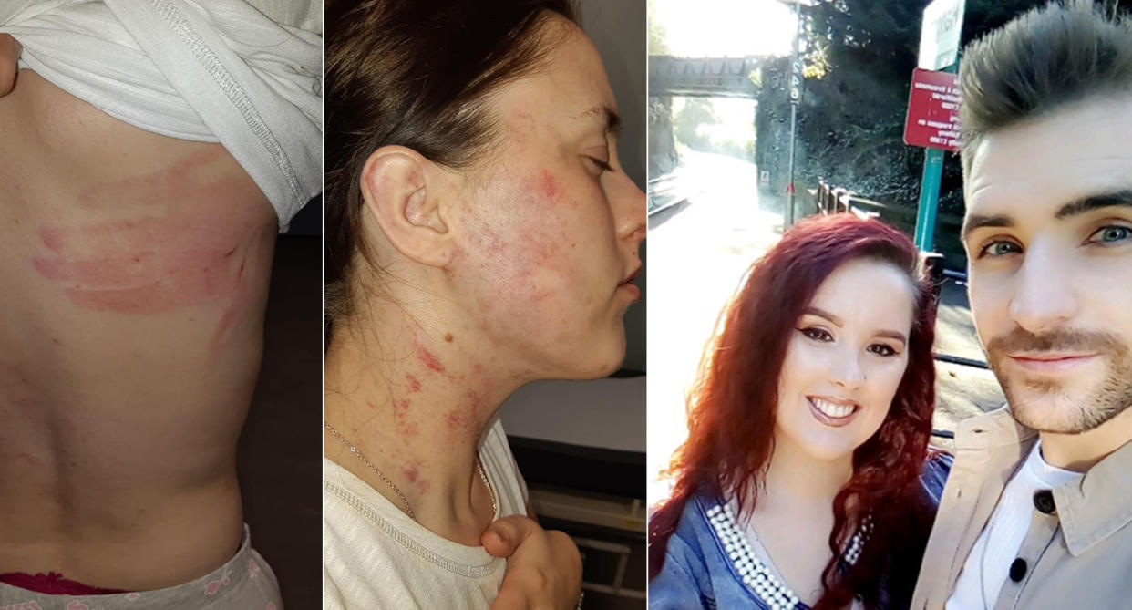 Jessica Gittings was left with marks across her body after Aaron Williams attacked her after her sister's wedding. (Wales News Service)