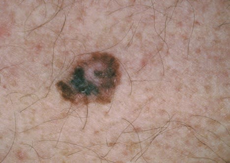 A variety of colors within the same mole is a warning sign to look out for. 