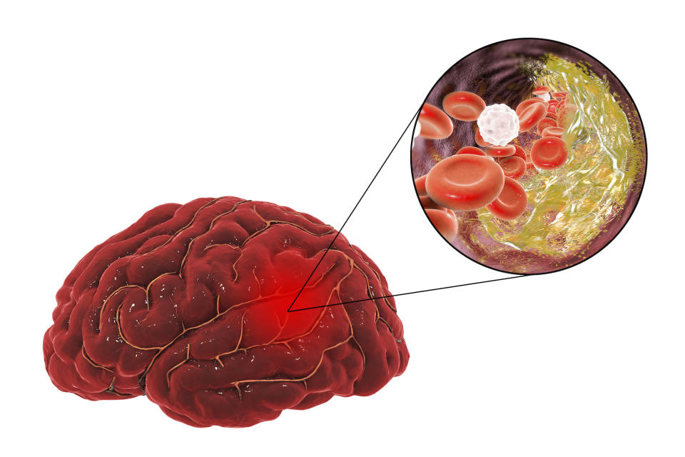 Ein Schlaganfall kann durch verstopfte Blutgefäße ausgelöst werden. Dabei kann das mit Sauerstoff angereicherte Blut nicht ungehindert zum Gehirn fließen. (Symbolbild: Getty Images)