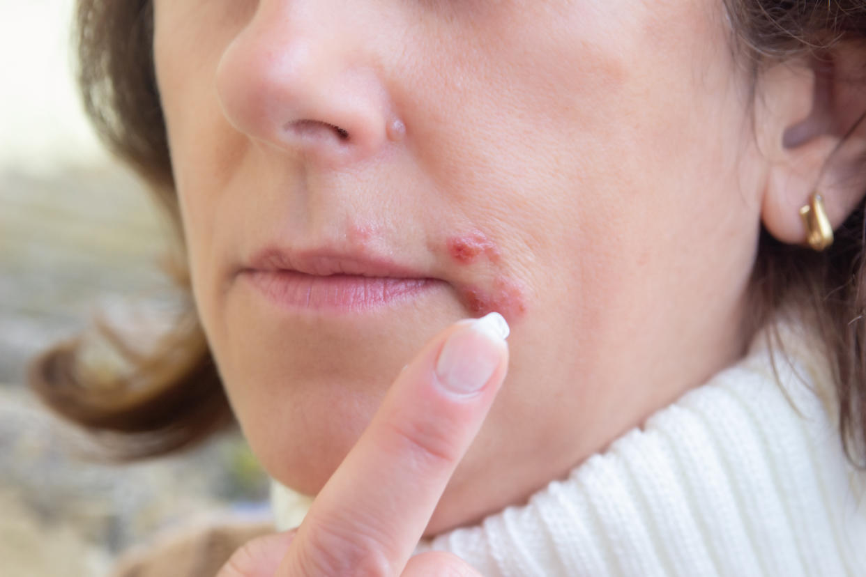 Me sacaron una muela y me dolió más una rozadura que se produjo en la boca, esta fue mi salvación. (Foto: Getty)