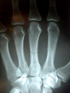 Luke Rockhold broken hand x-ray