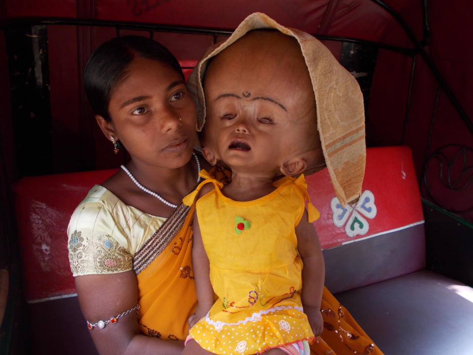 Fatima, the mother of Begum says her daughter is been suffering since she was born and the doctors in the region are unable to improve the condition of her child. Rehman, who works in a brick factory, says that they are unable to treat their daughter due to their financial problems.