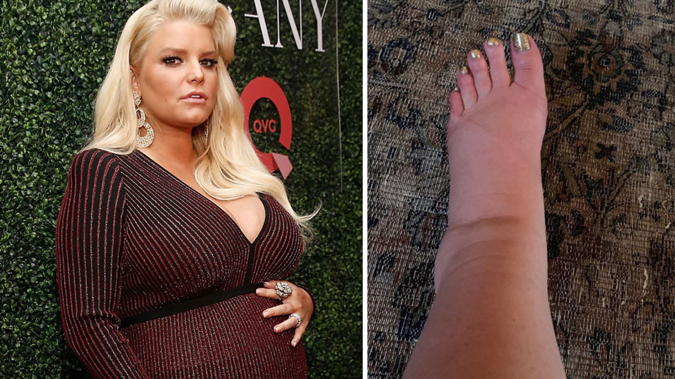 Jessica Simpson Finds Remedy for Extremely Swollen Foot