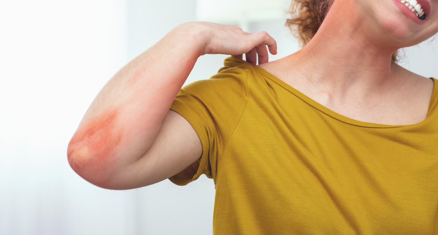 Why You Have Heat Rash And How To Treat It 