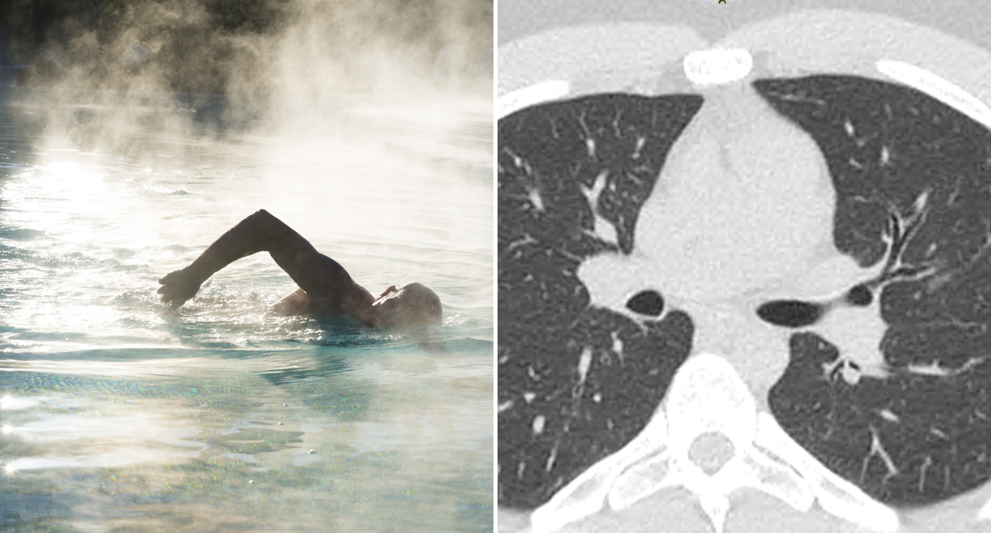 Queensland Boy 17 Contracts Hot Tub Lung From Family Pool