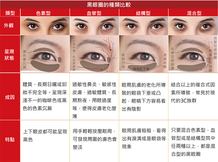 ▲判斷黑眼圈類型，可幫助治療更加精準。（圖/粹究美學診所提供）