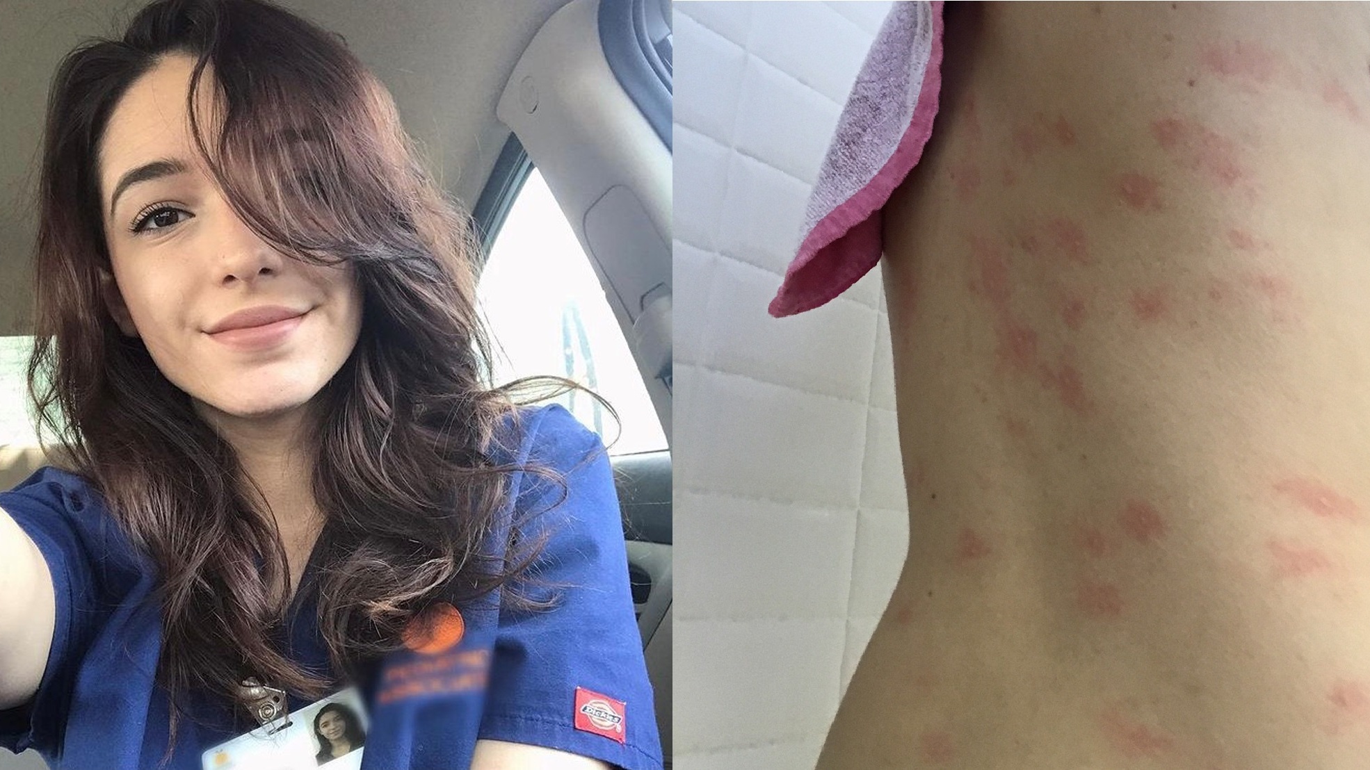 Water Allergy Brings Woman Out In Itchy Welts If She Gets Caught In The Rain