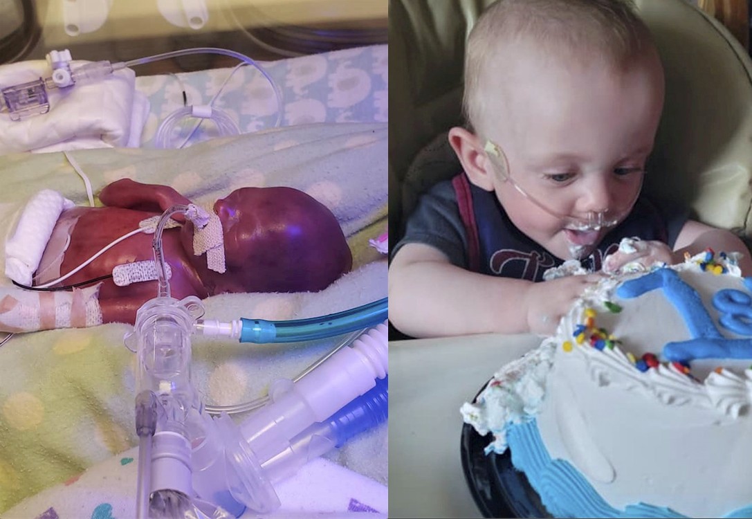 World S Most Premature Baby Celebrates First Birthday