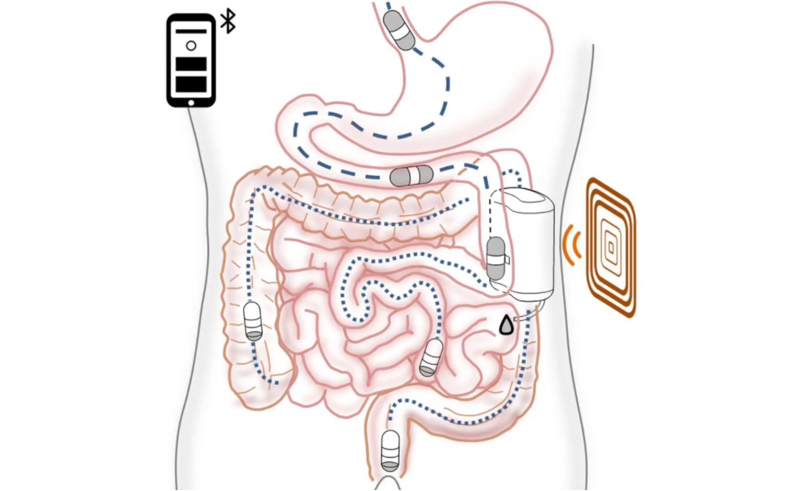 This ingestible robot delivers insulin to your body without external needles