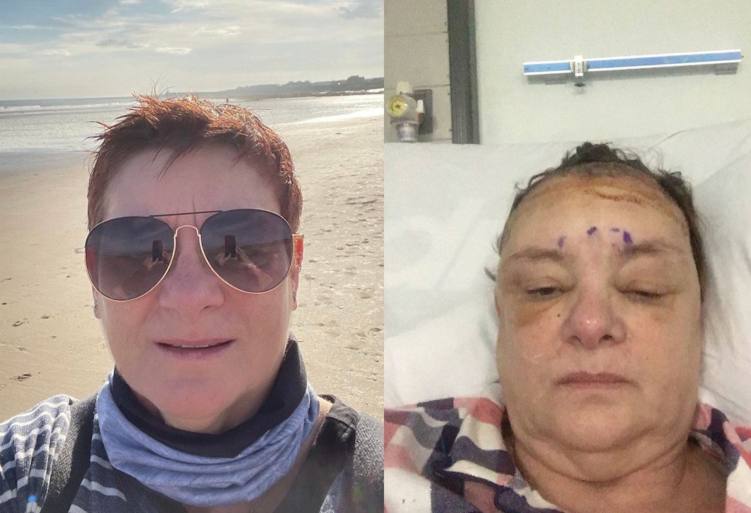 Resulta que el síntoma de la «menopausia» de mi madre es un tumor cerebral