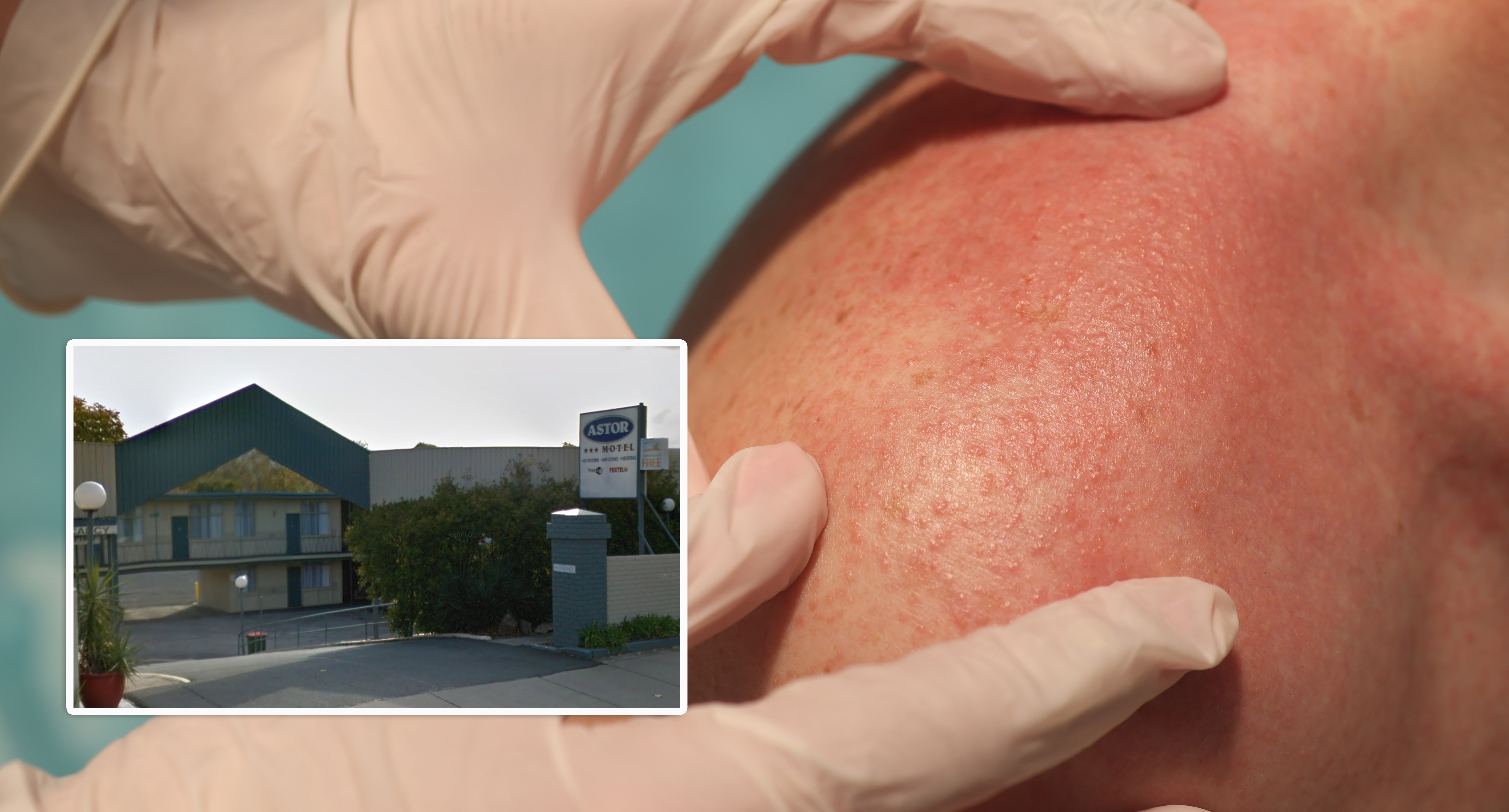 First measles case in two years puts two Aussie states on alert