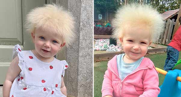 After baby goes viral, expert explains uncombable hair syndrome