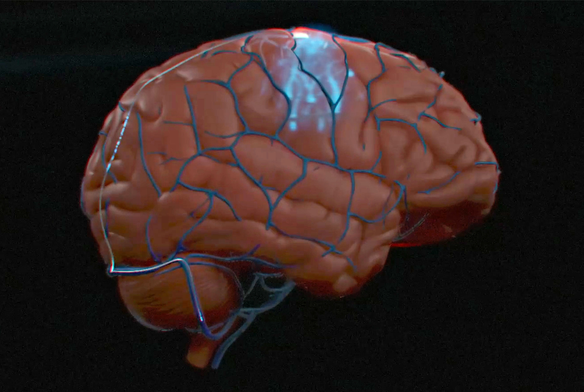 Synchron says it's the first to implant a human brain-computer interface in the US - Engadget