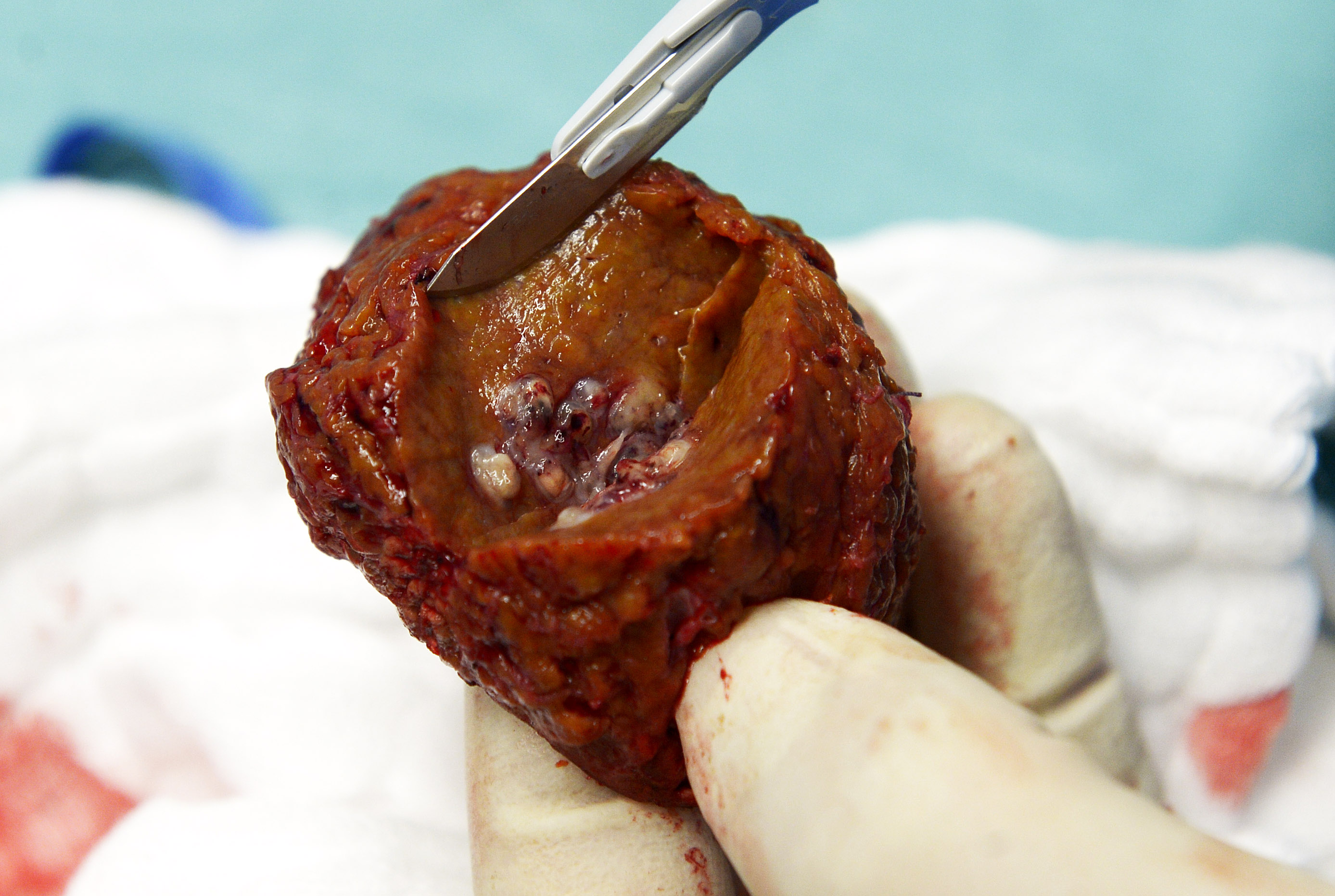 Professor Karl Oldhafer, chief physician of general and visceral surgery at the Asklepios Hospital Hamburg-Barmbek, shows a tumor inside a piece of a liver which was removed during surgery, one of the first surgeries of its kind in Germany with the support of a tablet computer to access and visualize planning data, in Hamburg August 15, 2013. The tablet computer uses augmented reality, which allows the liver to be filmed with an iPad and overlaid during an operation with virtual 3D models reconstructed from the real organ. Developed by Fraunhofer MEVIS in Bremen, this procedure helps locate critical structures such as tumors and vessels and is expected to improve the quality of transferring pre-operational resection plans into actual surgery.     REUTERS/Fabian Bimmer (GERMANY - Tags: HEALTH)