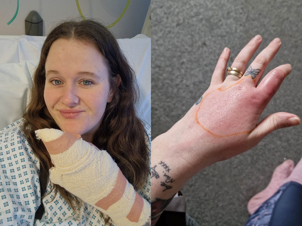 Widow Spider Bite Turned Out To Be A Spot On Womans Finger Trending News 