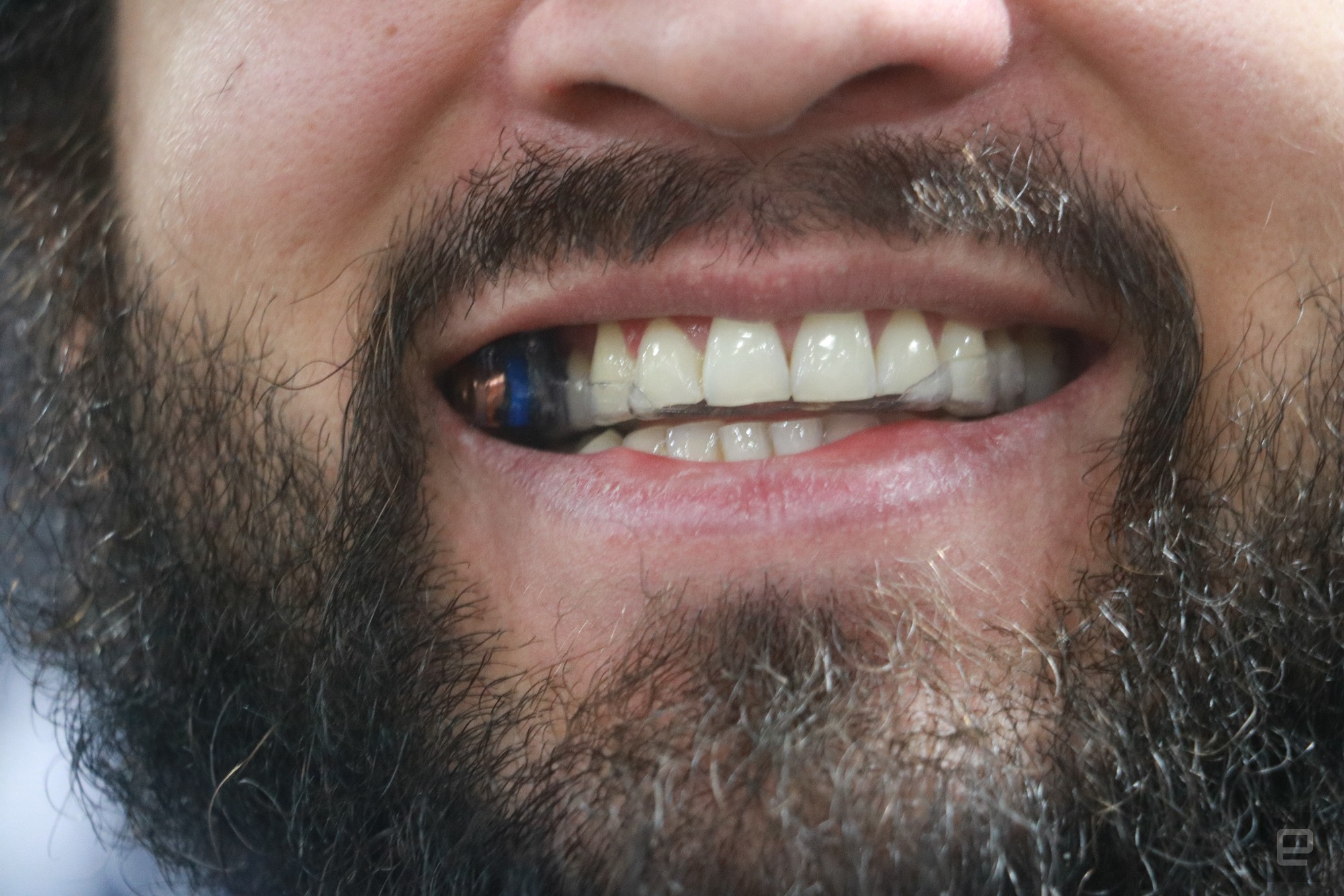 Close-up of smile of person wearing MouthPad 2024. Lines indicate a clear tray on the man's tooth and a small piece of equipment on one of the teeth on the right side of his mouth.