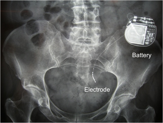 faecal-incontinence-treatment-options