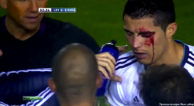 Cristiano Ronaldo left dripping with blood after he's whacked in